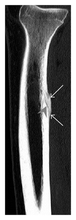 CT of tibial fracture.jpg