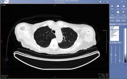 A CT scan of a patient's chest displayed