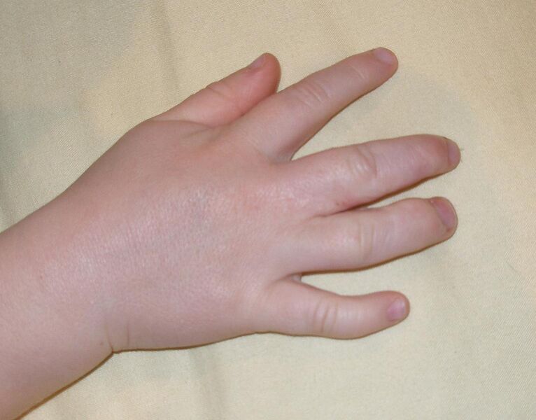 File:Child's hand, three years after surgery to rectify complete complex syndactyly of two fingers.jpg