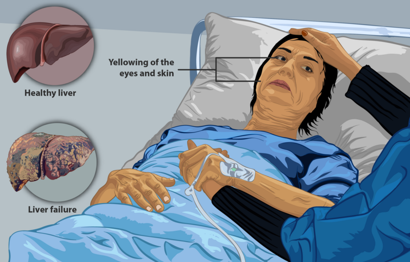 File:Depiction of a liver failure patient.png