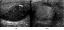 Scrotal ultrasonography of tuberculous epididymo-orchitis.jpg