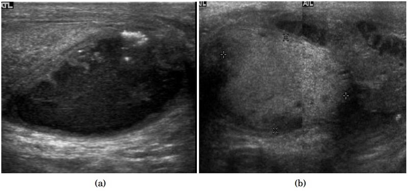 File:Scrotal ultrasonography of tuberculous epididymo-orchitis.jpg