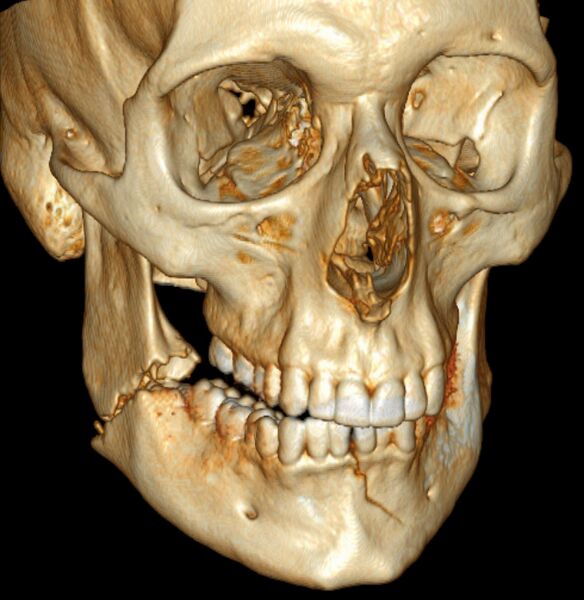 File:3D CT of bilateral mandible fracture.jpg