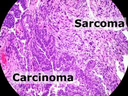 Carcinosarcoma of the endometrium - annotated.jpg
