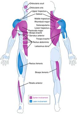 FSHDBodyDiagram.jpg