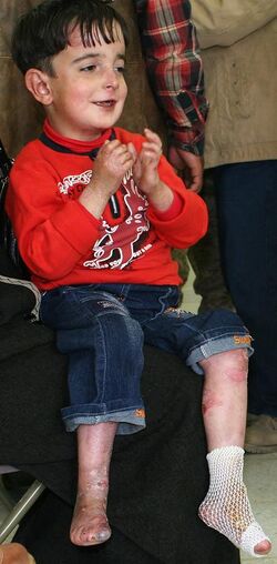 Iraqi-boy-epidermolysis bullosa-090216-M-8096M-001.jpg