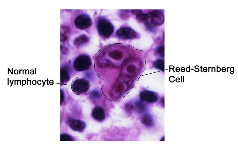 File:Reed-Sternberg lymphocyte nci-vol-7172-300.jpg