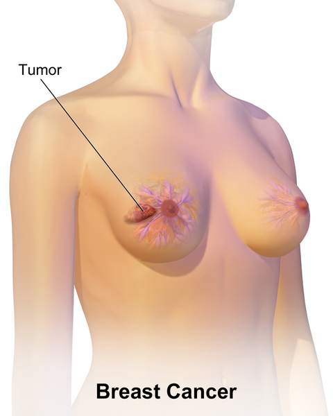 File:Breast Cancer.png