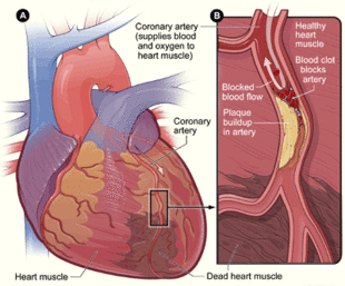 Heart attack-NIH.gif