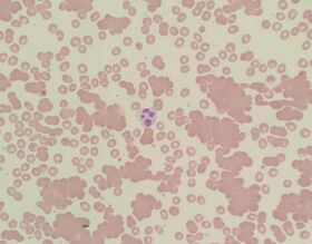 A photomicrograph of a blood smear showing red blood cells in clumps
