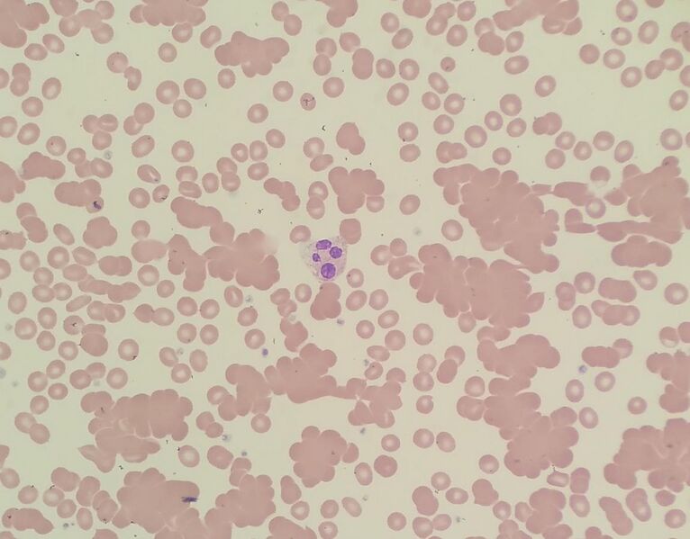 File:Red blood cell agglutination due to cold agglutinin.jpg
