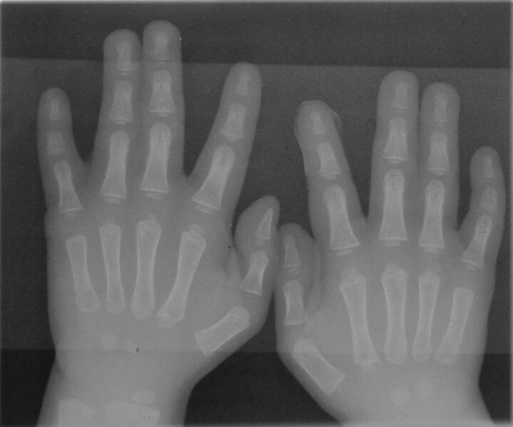 File:Syndactyly type1 hands.jpg