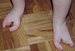 Oligodactyly, 2 toes on the feet of a one-year-old child