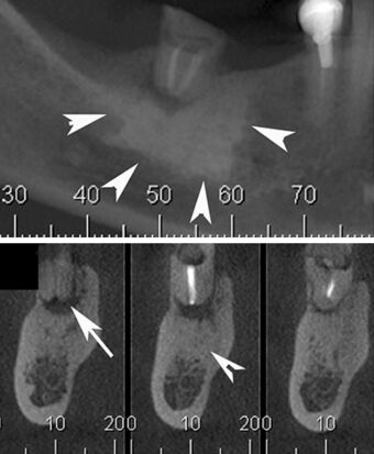 Jaw lesions - Condensing osteitis - Cone beam CT.jpg