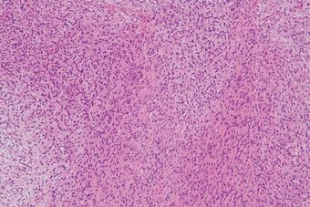Low-grade fibromyxoid sarcoma - intermed mag.jpg