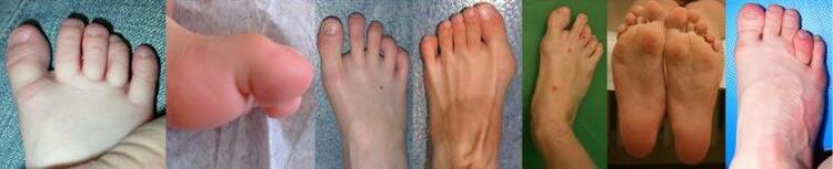 Pictures of the feet of NCBRS