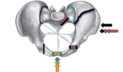 Pelvic Fracture Young-Burgess Classification.png