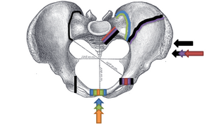 Superior view, Pelvic Fracture Types (2006). Force and break are shown by matching color: Anteroposterior compression type I (orange), Anteroposterior compression type II (green), Anteroposterior compression type III (blue); Lateral compression type I (red), Lateral compression type II (purple), F. Lateral compression type III (black). Increased force and breaks are shown by increasing size.