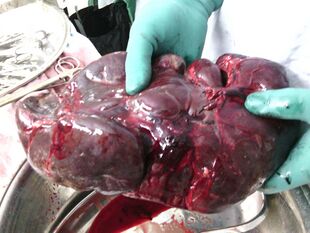 Spleen after spleenectomy.jpg