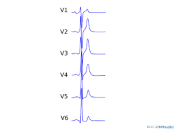 Sqts (CardioNetworks ECGpedia).svg