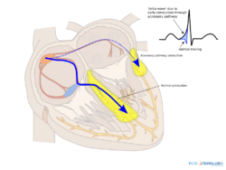 Wpw2 (CardioNetworks ECGpedia).svg
