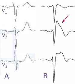 Normal electrocardiograms compared to electrocardiograms of people with Brugada Syndrome