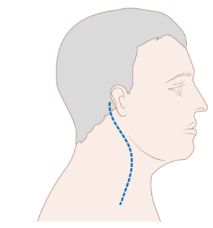 Diagram showing the scar line after lymph node dissection in the neck CRUK 368.svg