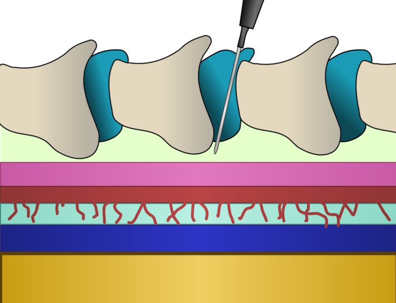 File:Epiduraldiagram.png