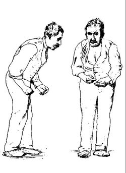 Parkinson’s disease 1880s.jpg