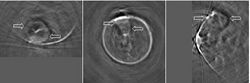 Thermoacoustic Image of Ductal Carcinoma in Human Breast.jpg