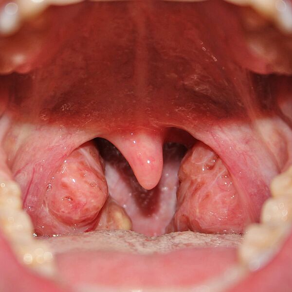 File:Throat with Tonsils 0012J.jpeg