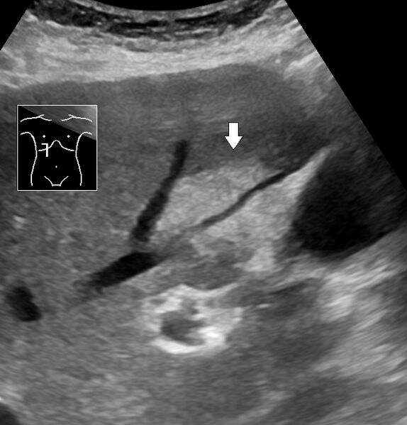 File:Ultrasonography of focal steatosis.jpg