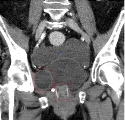 Artificial urethral sphincter - CT coronar 001.jpg