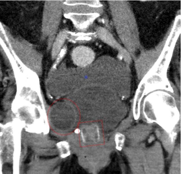 File:Artificial urethral sphincter - CT coronar 001.jpg
