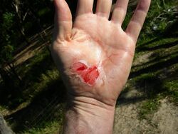 Bicycle injury - Hand Abrasion, Day 1.jpg