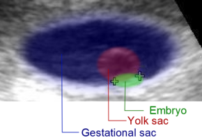 Ultrasound of embryo at 5 weeks, colored.png
