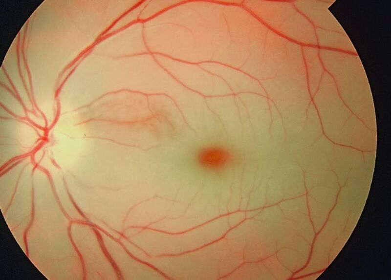 File:Cherry red spot in patient with central retinal artery occlusion (CRAO).jpg