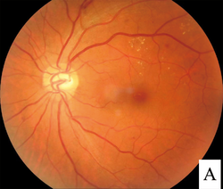 Fundus - diabetic retinopathy.png