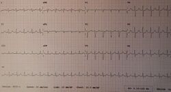 Junctional Tachycardia.jpg