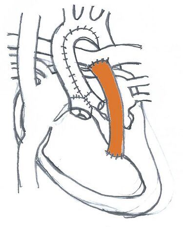 Medicine:Sano shunt - HandWiki