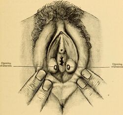 Illustration of vaginal abscesses.