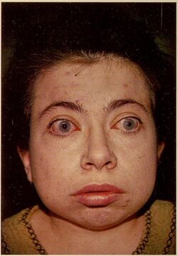 Mucopolysaccharidosis (Scheie's Syndrome) 1.jpg