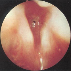 Subglottic stenosis 02.png