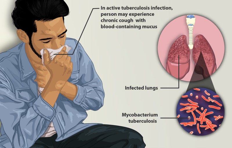 File:Depiction of a tuberculosis patient.png
