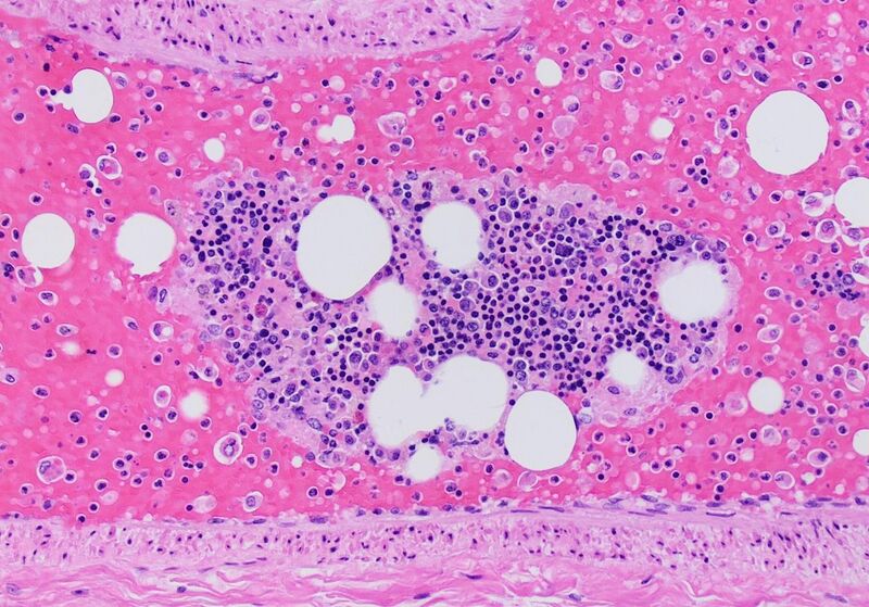 File:Histopathology of a pulmonary artery with fat embolism and a bone marrow fragment.jpg