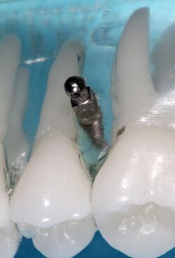 Implant orthodontic anchor model.jpg