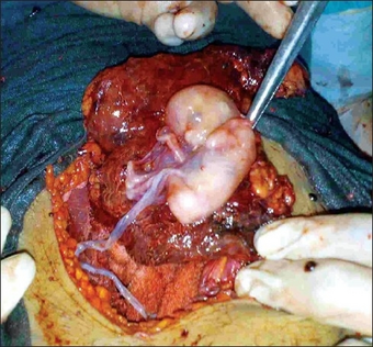 Intra-abdominal fetus being delivered.png