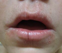 Lip licker's dermatitis 2.jpg