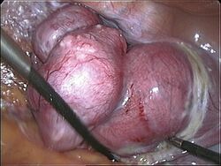The uterus being removed in a laparoscopic vaginal hysterectomy