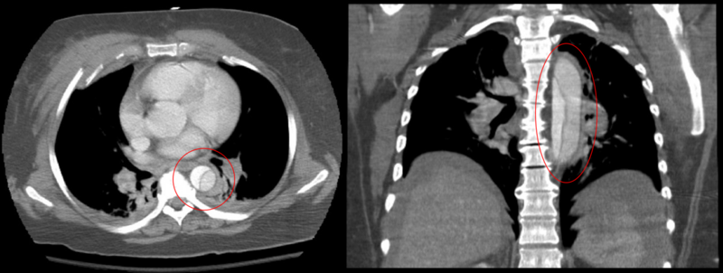 File:Descending (Type B Stanford) Aortic Dissection.PNG